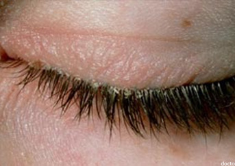 Blepharitis2 343x243