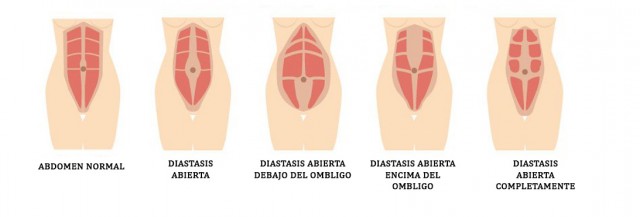 DIASTASIS