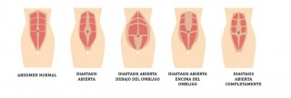 DIASTASIS