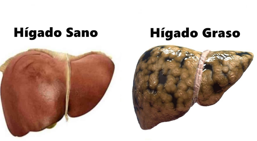 higado graso