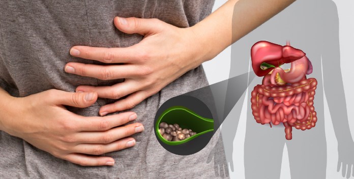 mejores remedios caseros para los cálculos biliares